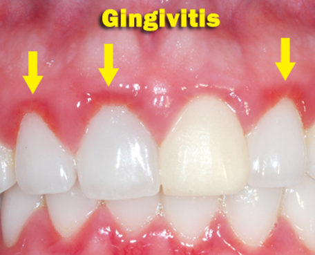 Gingivitis (Tandvleesontsteking)