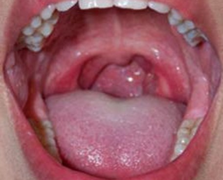 hpv virus keel