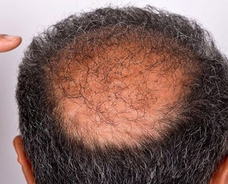Alopecia androgenetica (Klassieke mannelijke -